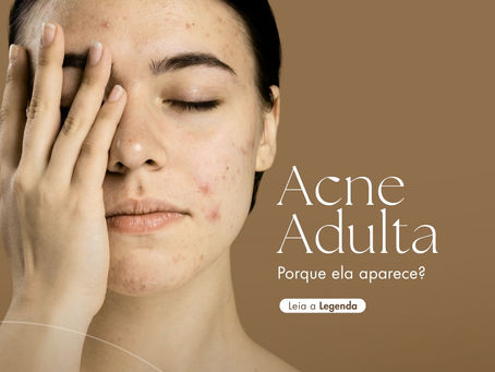 Acne adulta porque ela aparece e quais são os tratamentos mais indicados