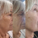 facial-rejuvenation-with-polynucleotides-before-after-mrs-fillers-aesthetics-portsmouth