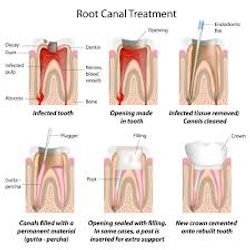 Root Canal Treatment  การรักษารากฟัน