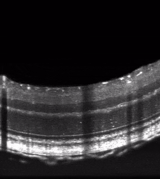VisOCT B-scan Gif