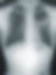 X-ray showing Pneumonia_edited.jpg