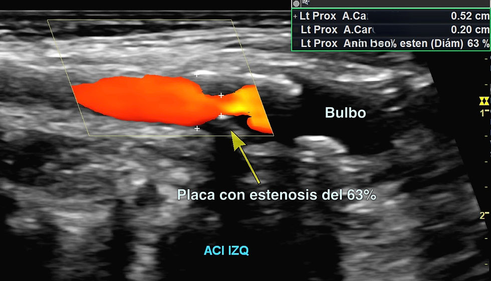 Doppler carotídeo con placa de ateroma que causa estenosis y es de riesgo para embolia