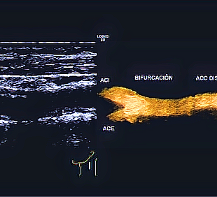 Imagen de Doppler carotÃdeo realizado por Dr. Carlos Maury, Médico Radiólogo en CITA Altabrisa, caracterización de engrosamiento de pared Ãntima-edia, y cambios leves por aterosclerosis carotÃdea.