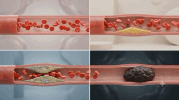 ATEROMATOSIS_CAROTIDEA_DR_CARLOS_MAURY_DOPPLER.gif