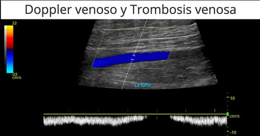 Doppler venoso y trombosis venosa profunda — artículo del blog