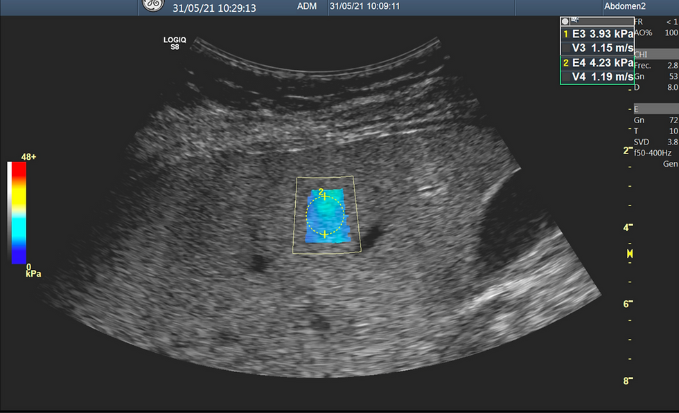 Elastogragía hepática con Logiq S8 del Dr. Carlos Maury