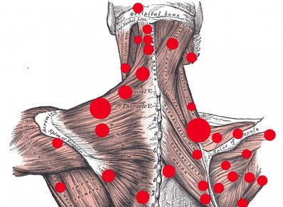 A map of trigger points