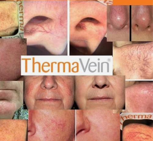 Thermavein, thread veins, spider naevus, cherry angioma, rosacea, telangiectasia