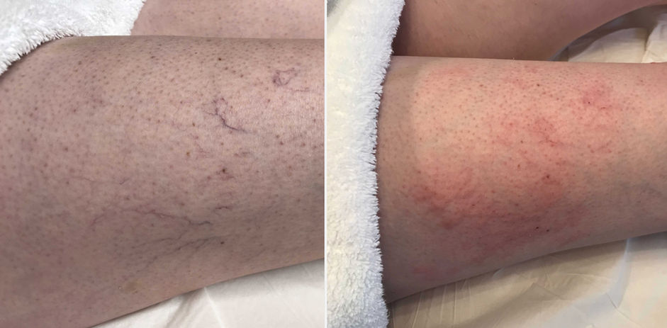 thread veins, Thermavein, leg veins, facial thread veins