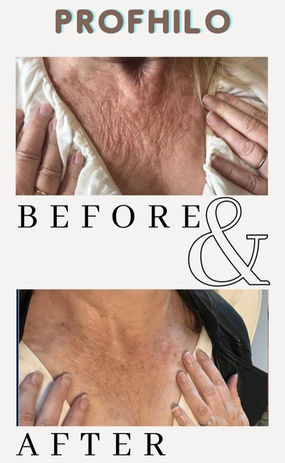 profhilo, décolleté, skinbooster