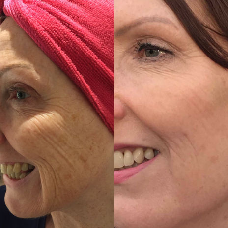 Profhilo, skinbooster, wrinkles