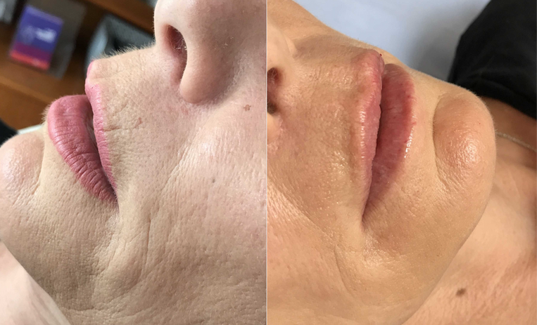 lip filler, dermal filler, lip augmentation