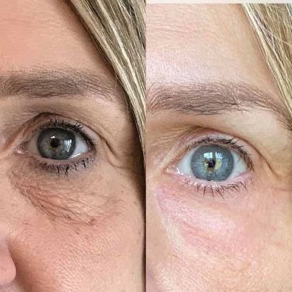 plexr plasma skin tightening, under eye skin tightening, non-surgical blepharoplasty