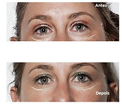 antes depois facelift.jpg