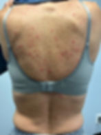 56 Year Old Female Rash Before