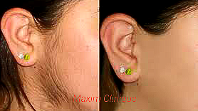 Sideburns Diode Laser Hair Permanent Remove