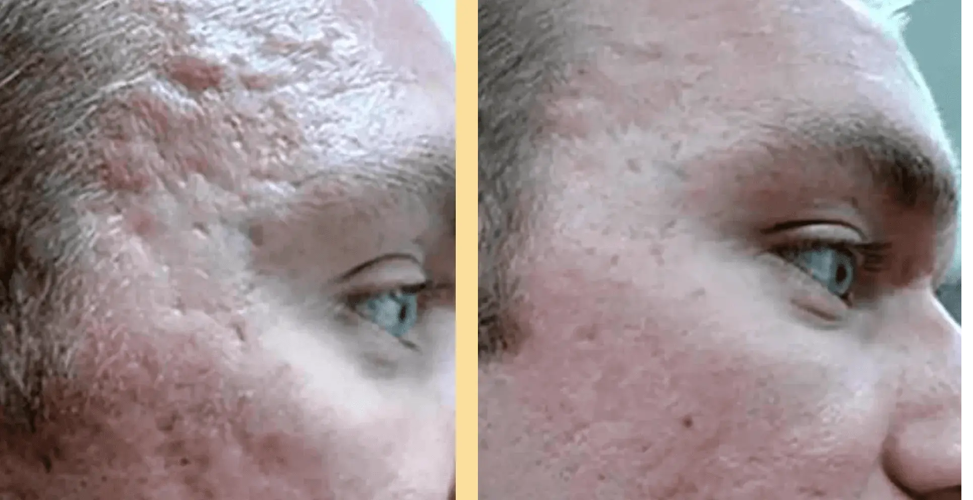 Microneedling for scarring at Rosem Health West Bridgford