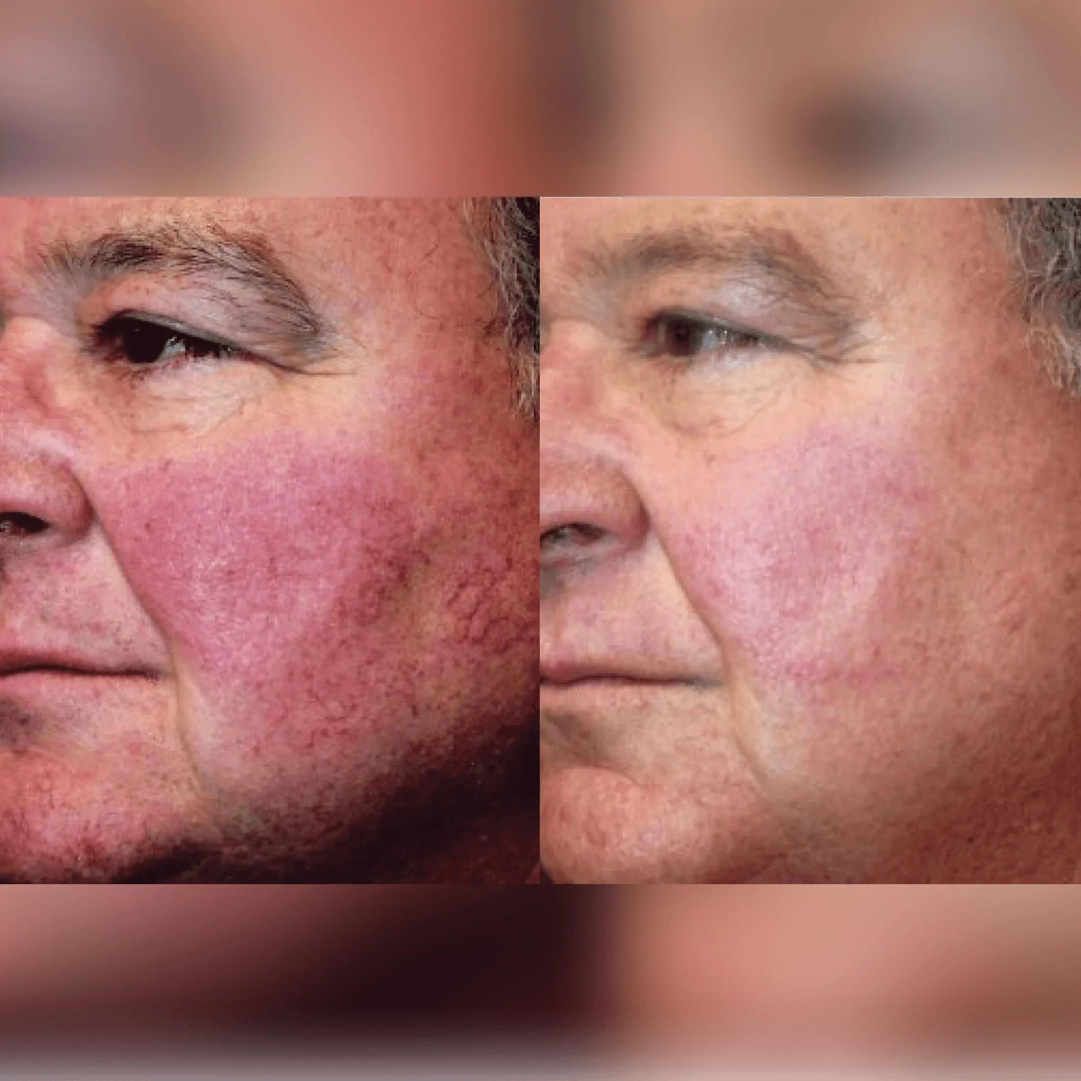 Rosacea and redness skin treatment     Skin Booster injections at Rosem Health West Bridgford
