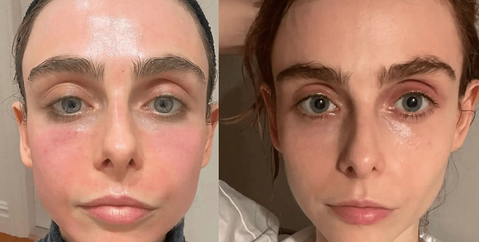 Chemical Peels at Rosem Health in West Bridgford