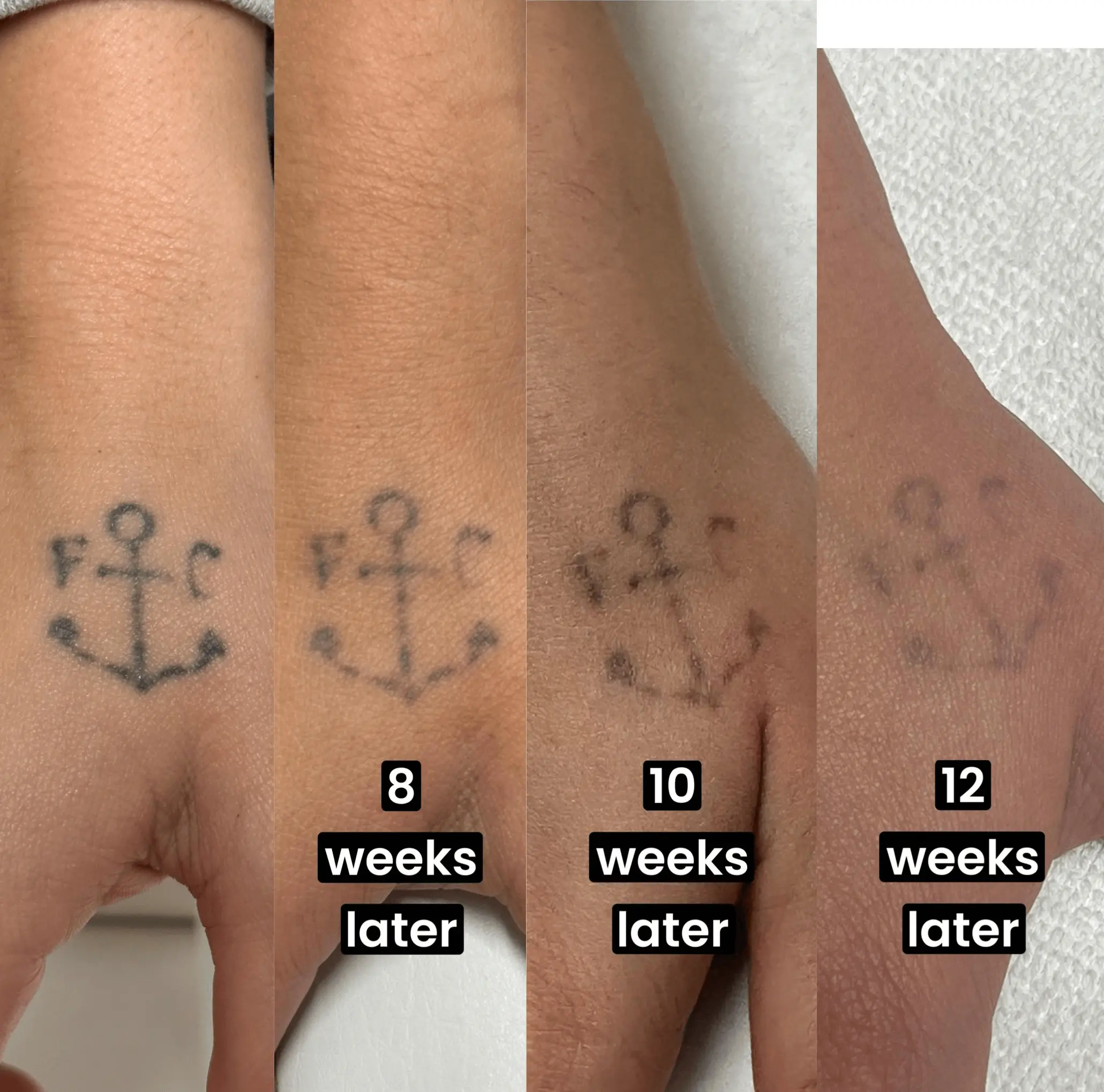 small tattoo rmeoval     Skin Booster injections at Rosem Health West Bridgford