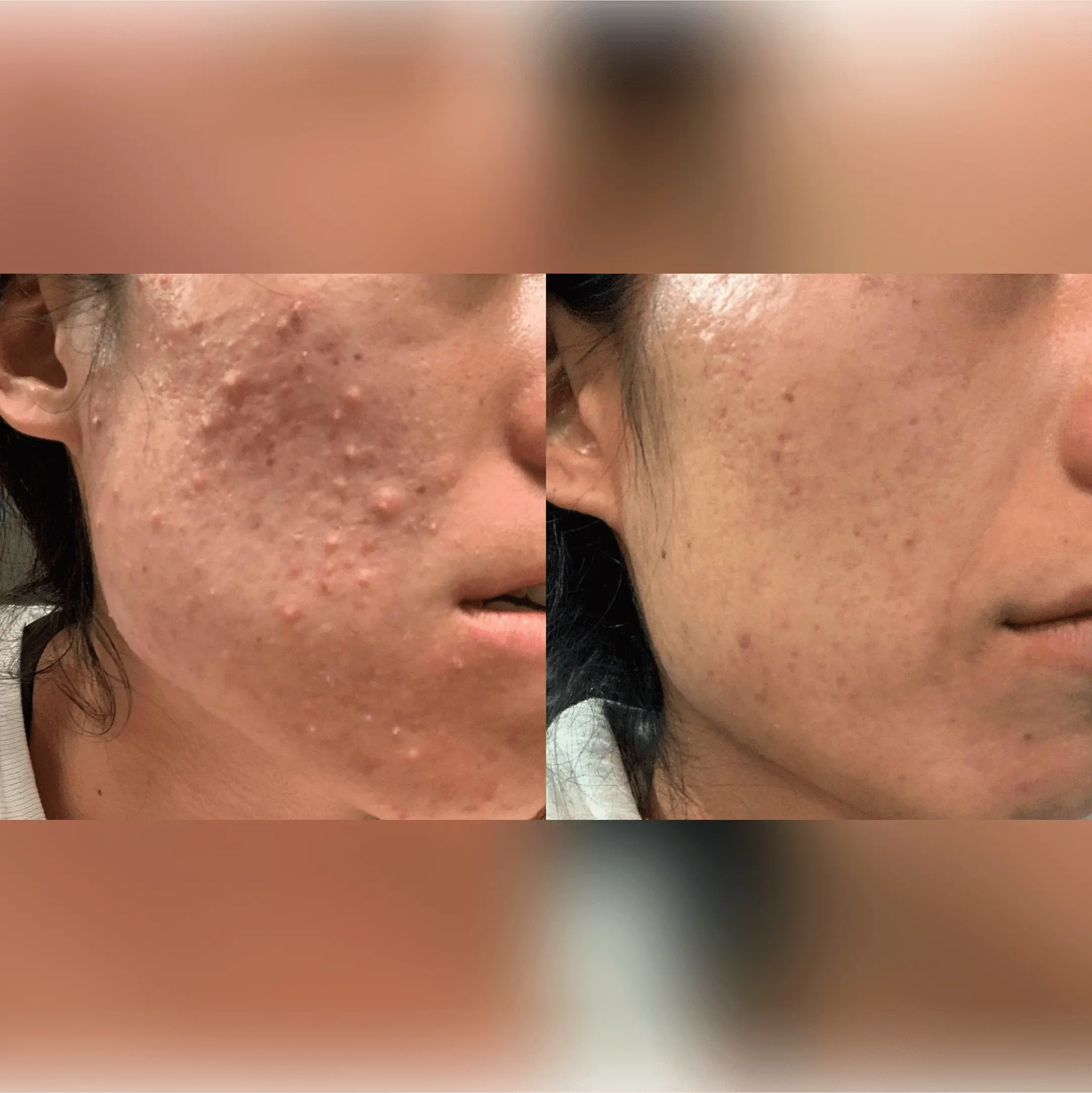 A patients before and after acne transformation with chemical peels 