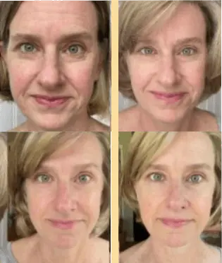 Before and after resultds of hifu treatment at Rosem in Nottingham
