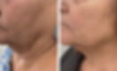 Three sessions of Radiofrequency Microneedling at Rosem Health West Bridgford - 3 months apart
