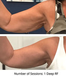 rf needling before and after results