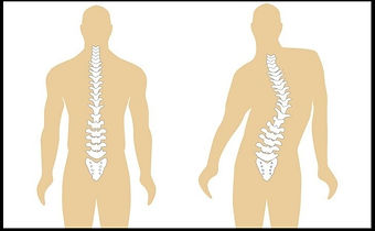 escoliose 1_edited.jpg