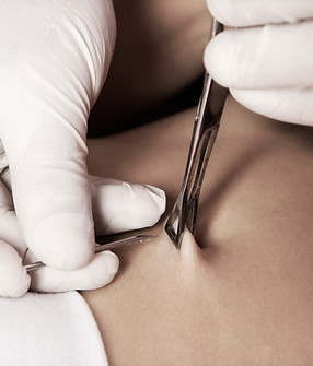 Minor Operations Clinic is for diagnosis and removal of warts, moles, keratosis, lipomas, cysts, ingrown toenails and many other benign and malignant skin lesions.

Cryotherapy, curettage, punch biopsies, shave excisions and surgical excision are also available.

All specimens removed are sent to histology. 