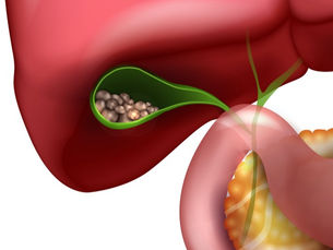 piedras en la vesícula (litiasis vesicular)