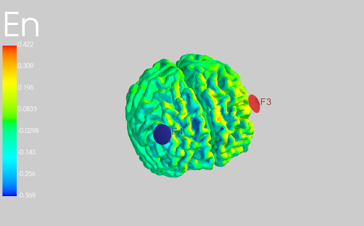 Neurotwins Personalizing Digital Brains - Electric field simulation