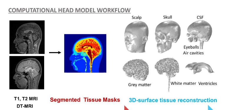 Neurotwins: Personalizing Digital Brains- Computational Head Model Workflow