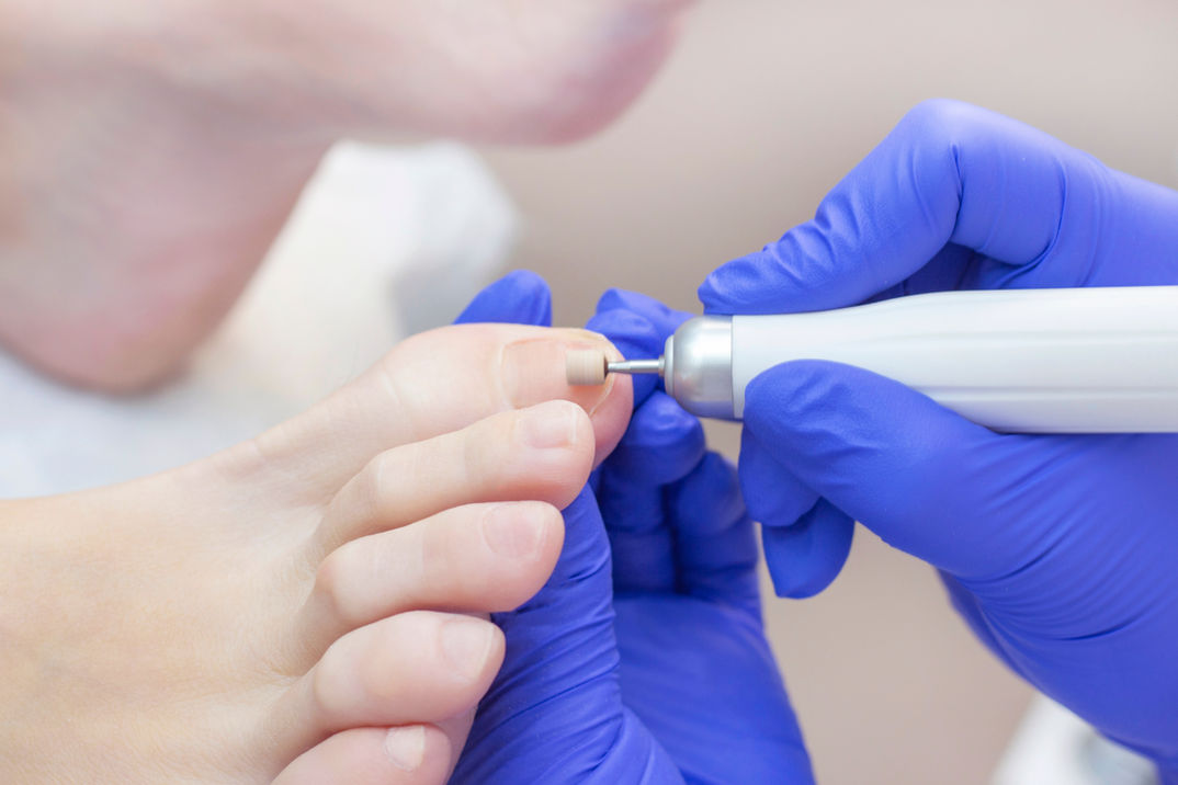 A podiatrist using a dremel tool to sand a patient's toenails