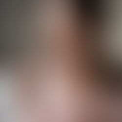 Oral Minoxidil For Hair Loss