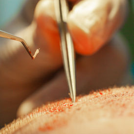 Timeline for Pharmaceutical Treatments Before, During, and After a Hair Transplant