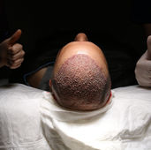 Why You Need Pharmaceutical Hair Loss Treatments Even After a Hair Transplant