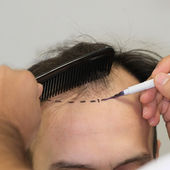 How Long Do Hair Transplants Usually Last?