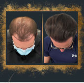 Transform Your Hair: The Critical Role of Pharmaceutical Treatments in Hair Transplants
