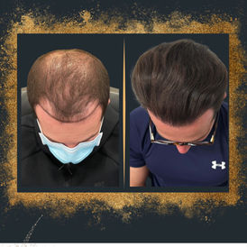 Transform Your Hair: The Critical Role of Pharmaceutical Treatments in Hair Transplants