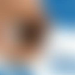 Pinguécula - O que você precisa saber