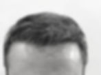 The canopy effect illustrated through strategic layering of multi-hair grafts directly behind an undetectable hair transplant hairline design.