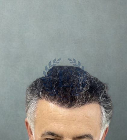 Hair transplant before after at eva estetica istanbul