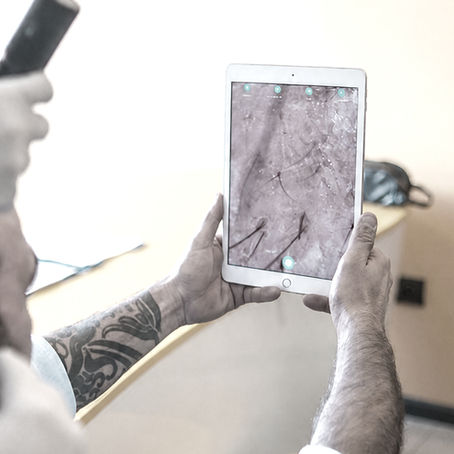 Microscopic clinical assessment of hair calibre and donor capacity to achieve maximum hair transplant density