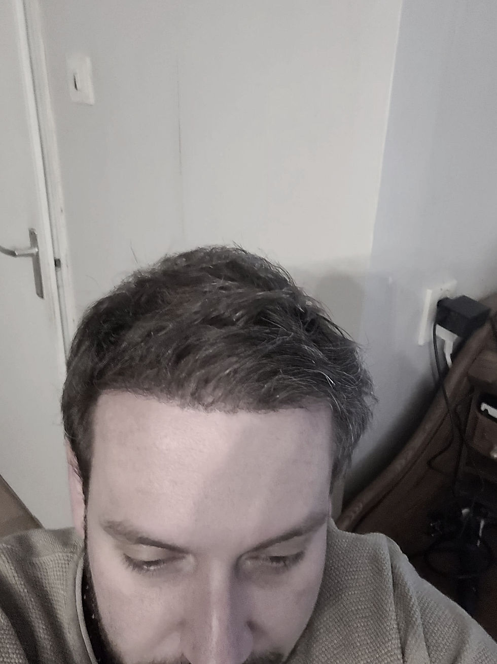 Close-up of a dense, natural hairline result that ages with quiet dignity and respects facial proportions.
