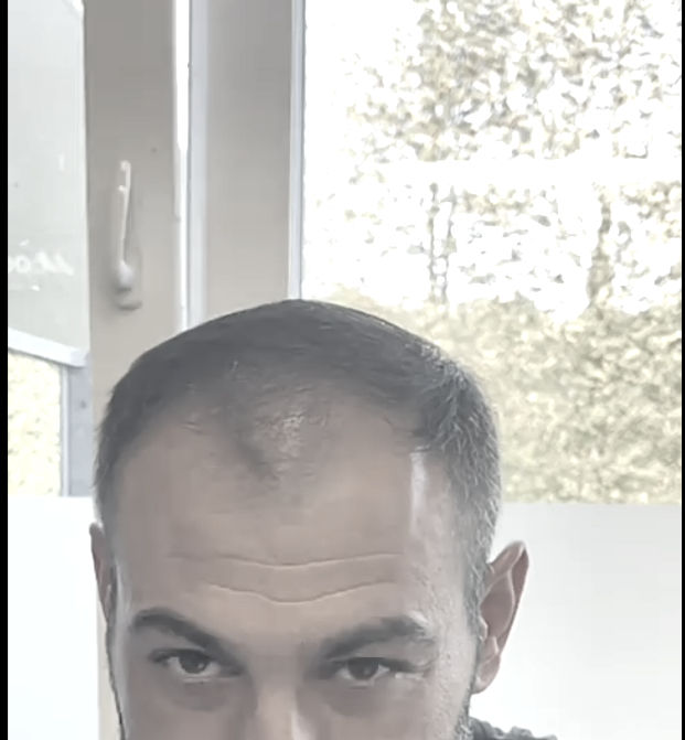 before and after hair transplant showing age appropriate frontal restoration