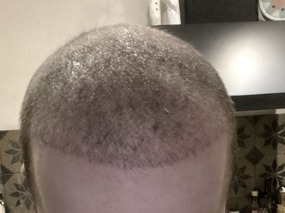 The vascular network of the scalp and its role in preventing permanent shock loss during hair restoration.