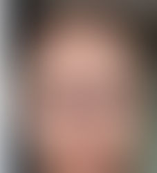 natural hair transplant before and after with refined hairline