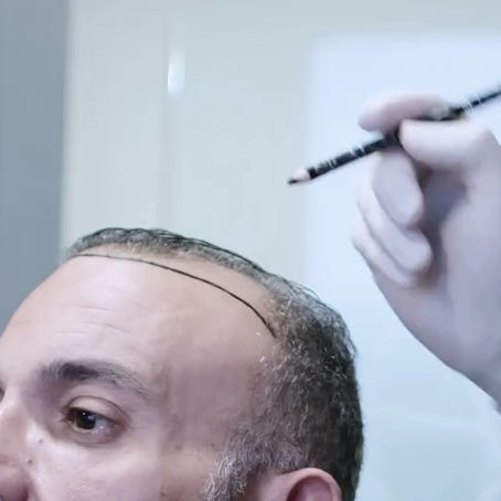 Pre-surgical hairline design and consultation for a DHI hair transplant at Eva Estetica Istanbul