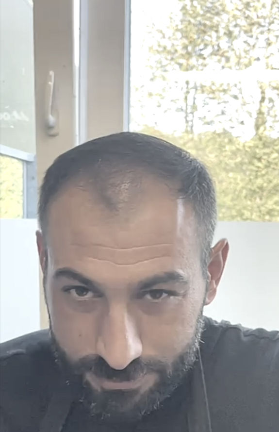 A high-resolution hair transplant before and after result showcasing an undetectable hairline design and naturally restored temple points.
